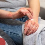 Eczema: What It Is, Symptoms, Causes, Types & Treatment