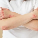 How to Prevent Common Skin Infections and Protect Your Health