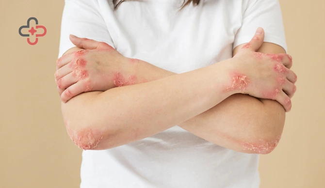 How to Prevent Common Skin Infections and Protect Your Health