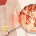 What Is a Yeast Infection and How Can You Prevent It?