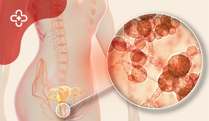 What Is a Yeast Infection and How Can You Prevent It?