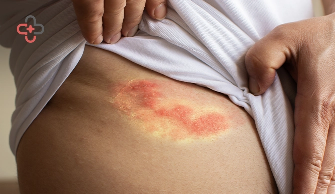 Fungal Infection on Skin Causes, Symptoms and Treatment Options
