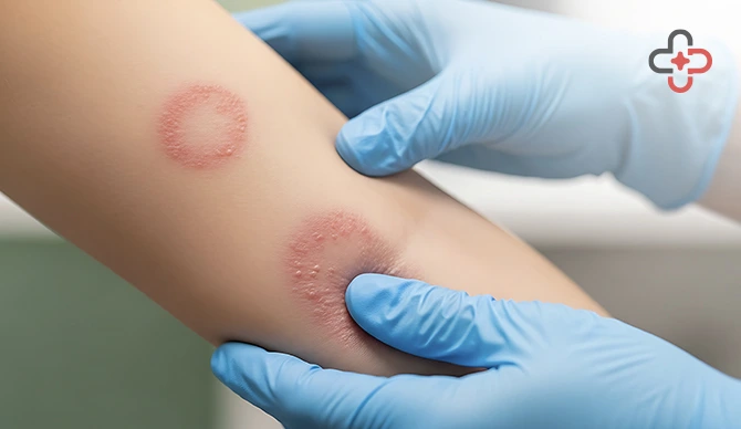 Red Circle on Skin Not Itchy Is It Ringworm or Something Else