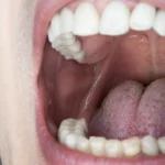 Roof Of Mouth Hurts Common Causes And How To Find Relief