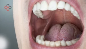 Roof Of Mouth Hurts Common Causes And How To Find Relief