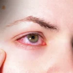 How To Get Rid Of A Stye A Step-By-Step Treatment Guide