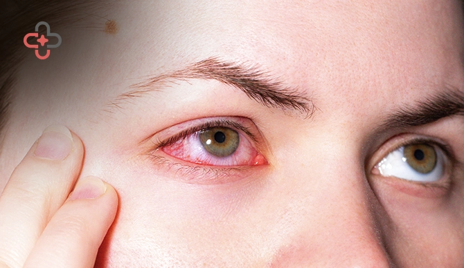 How To Get Rid Of A Stye A Step-By-Step Treatment Guide